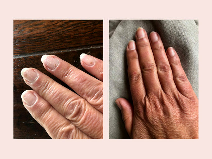 Beste Nagelbehandlung Für Beschädigte Nägel – Stellen Sie Ihre Nägel Wieder Her